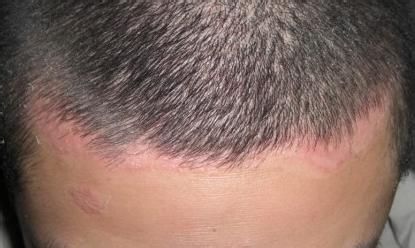 郑州银屑病医院